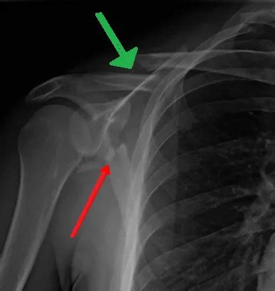 shoulder blade fracture shield